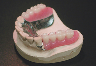 金属床義歯写真